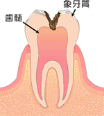 神経まで達したむし歯