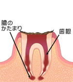 歯の根まで進行したむし歯歯