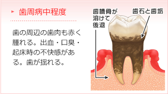 歯周病中程度　歯の周辺の歯肉も赤く腫れる。出血・口臭・起床時の不快感がある。歯が揺れる。